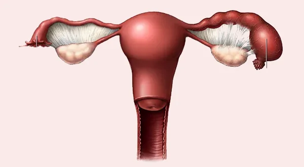 Pelvic Inflammatory Disease (PID) Treatment