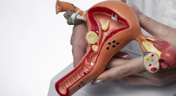 Polypectomy